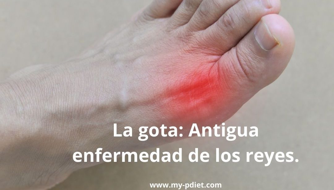 La gota: ¿La enfermedad de los reyes?, nutricionista, nutricionista clínica