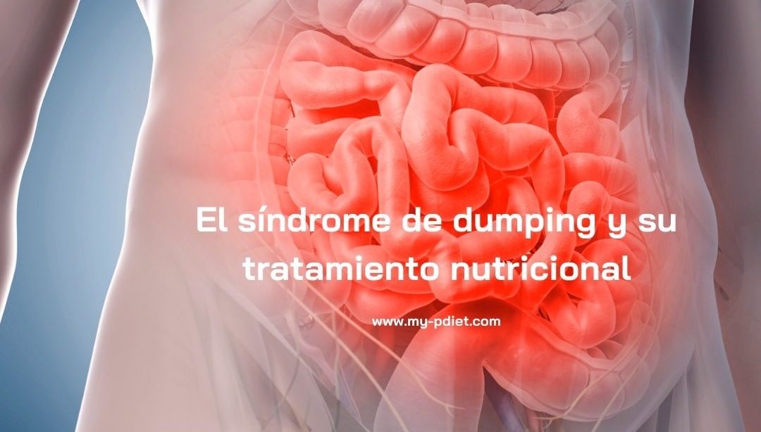 El síndrome de dumping y su tratamiento nutricional, nutricionista, nutricionista clínica
