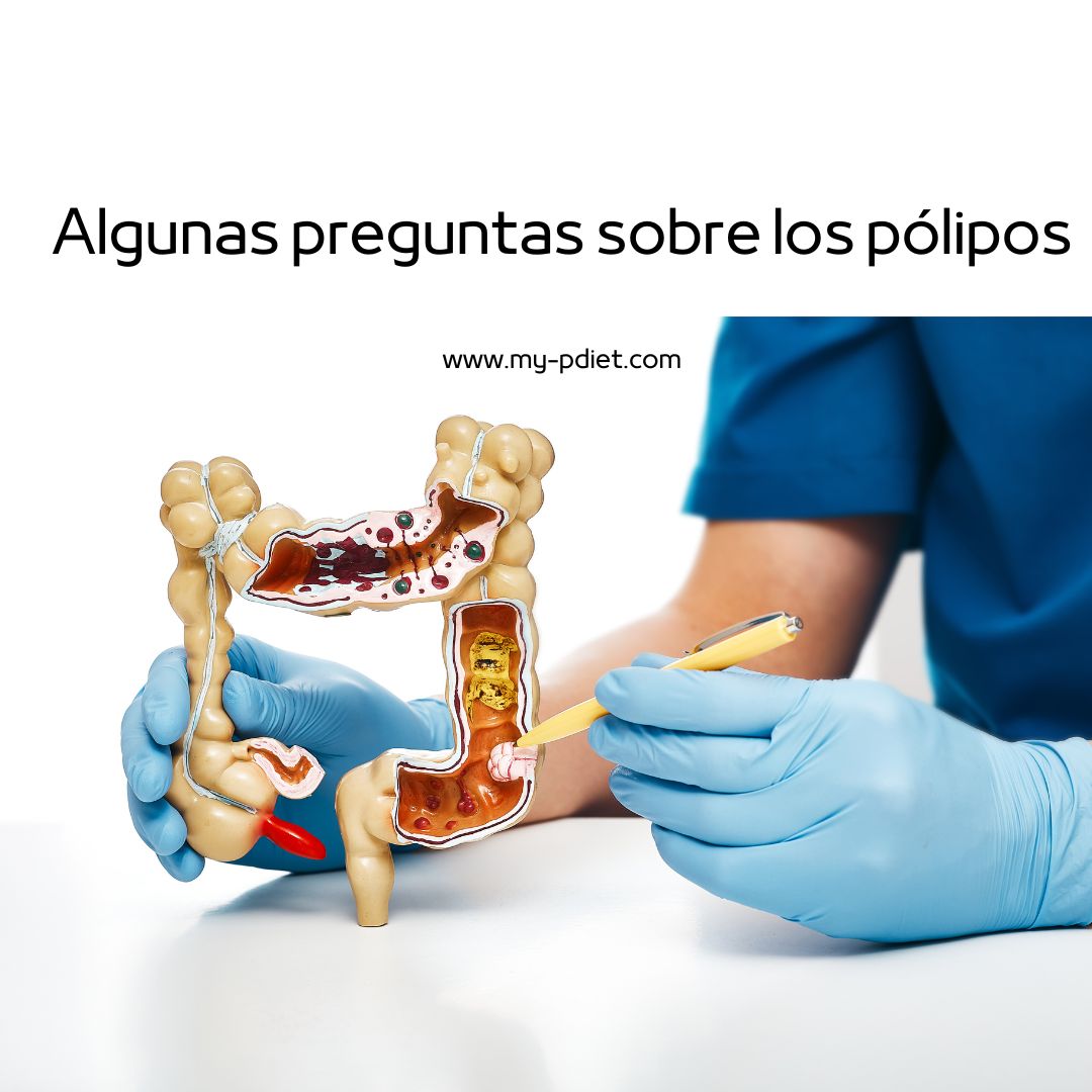 Algunas preguntas sobre los pólipos - Nutrición Algunas preguntas sobre los pólipos - Nutrición