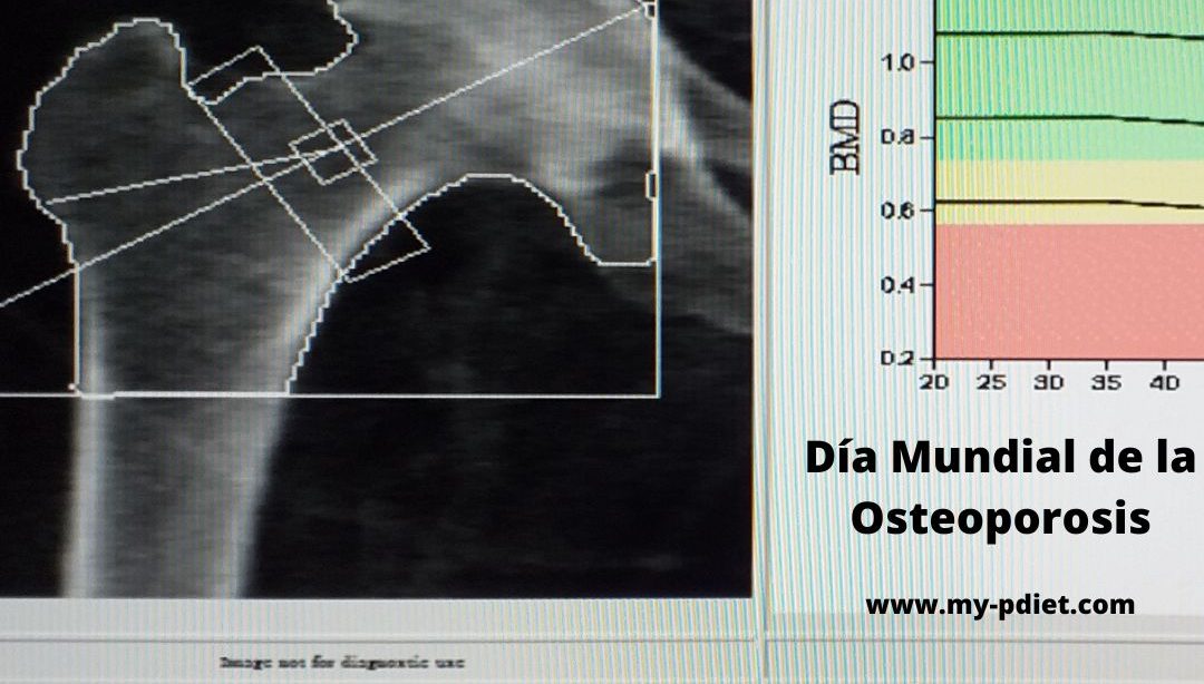 Día Mundial de la Osteoporosis, nutricionista, nutricionista clínica